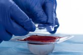 Loosening the ActiGraft clot with the plastic ring
