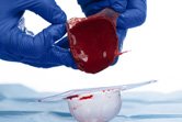 Applying the ActiGraft clot to the wound bed