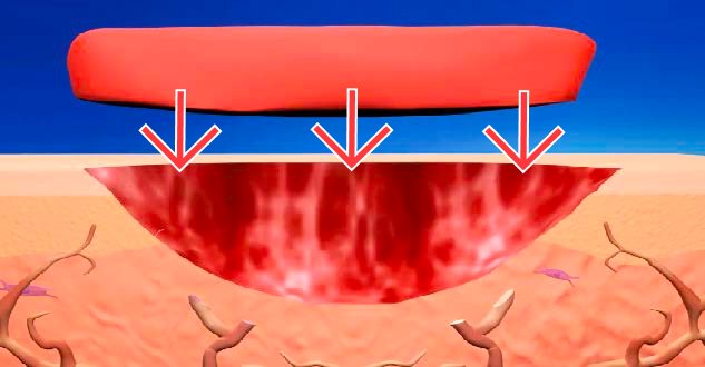 ActiGraft applied directly to the wound surface