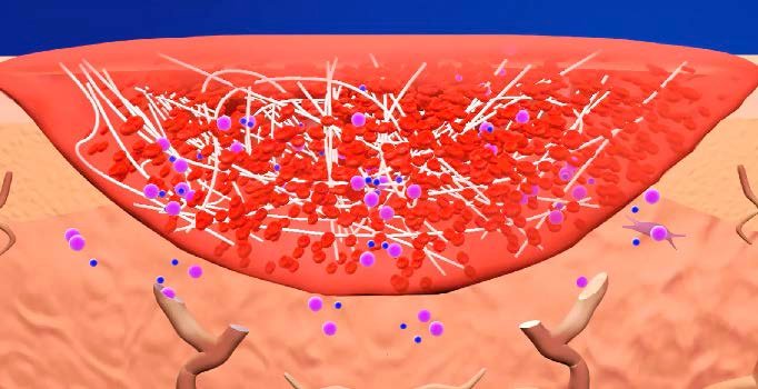 ActiGraft whole blood clot matrix in the wound bed