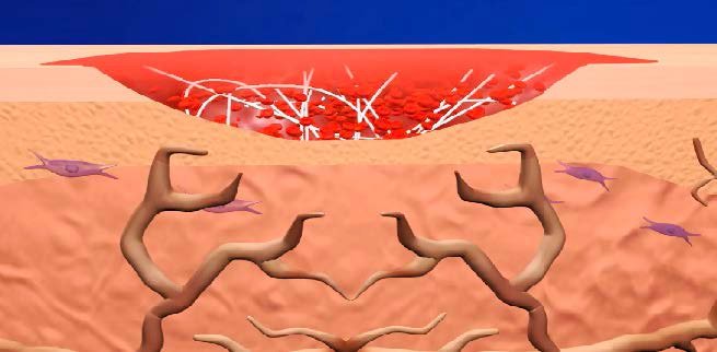 ActiGraft serving as a protective covering