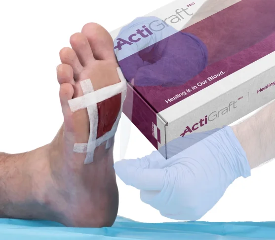 ActiGraft box and foot treatment